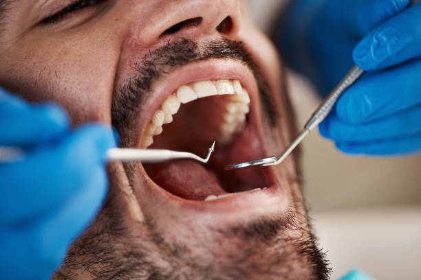 Best Emergency Tooth Extraction in Fountainebleau, FL